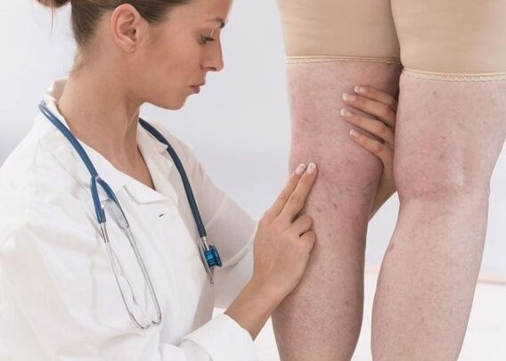 Diagnoza żylaków