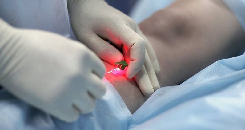 Chirurgiczne leczenie żylaków